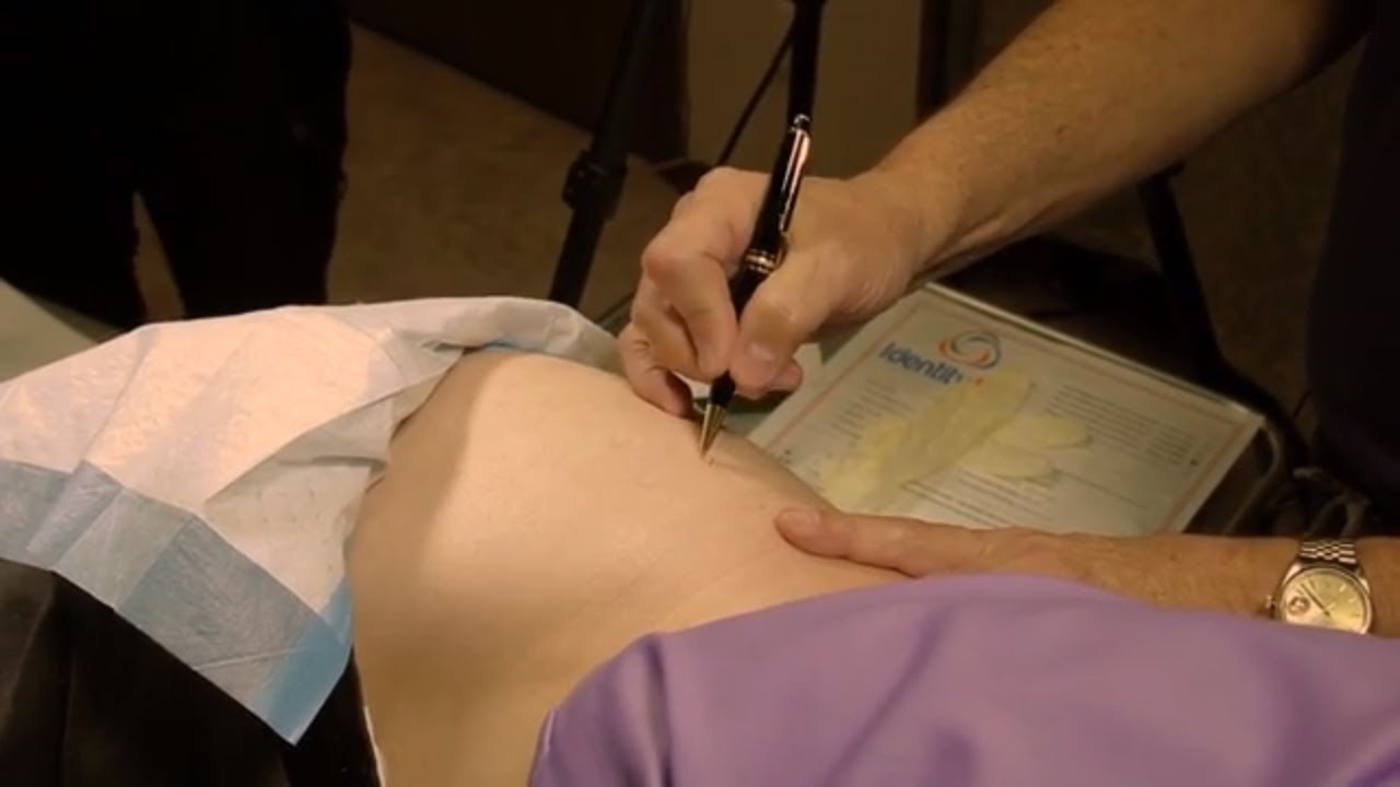 Implant Treatment for Alcoholism